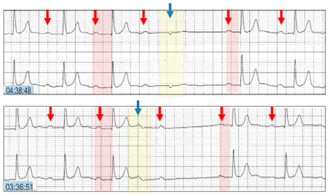 cardioscanUK's tweet photo. In this week's clinical case, Dr Harry Mond explores the various #arrhythmic events that can interrupt and terminate #Wenckebach AV sequences including non-conducted #atrial ectopics. Read more: https://t.co/XoDHieQTBA #ECG #epeeps #cardiology https://t.co/BpYx8dZvx6