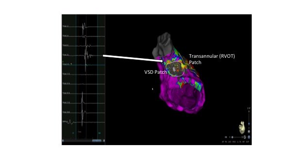 SMathewi's tweet image. VT Ablation in repaired Tetralogy of Fallot. Identification of surgical Patches and critical isthmus with #HDMap and pacing maneuvers. #epgiessen #VTAblation 
⁦@jorn_schmitt⁩ ⁦@HolgerNef⁩ ⁦@Phiso_de⁩ ⁦@ChristianHeeger⁩ ⁦⁩ ⁦@YoungDgk⁩