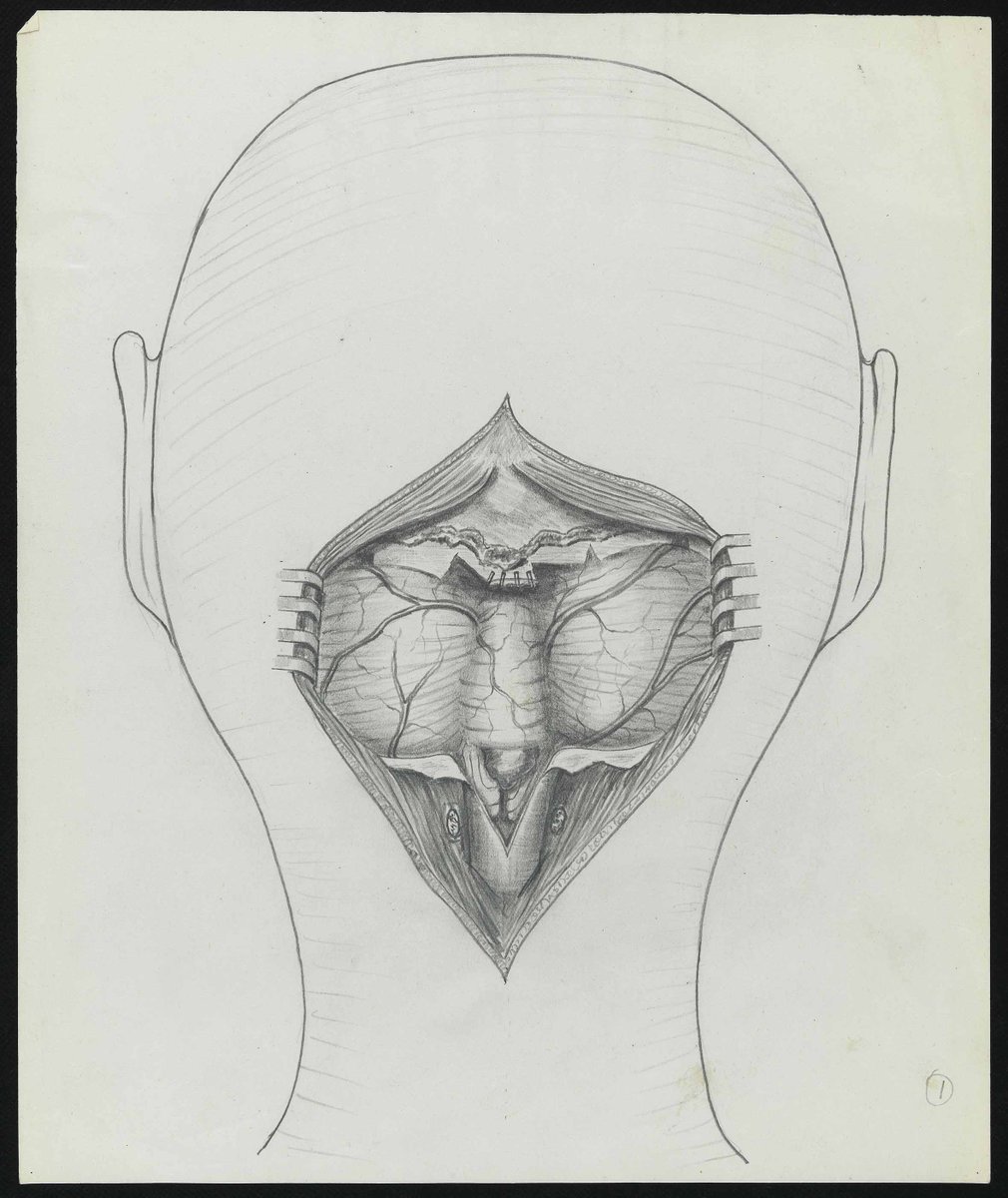 Norman Dott emphasised the importance of good medical illustration and used professional medical artists to document his work and publications. In this blog our previous conservation intern Judith discusses rehousing these drawings: bit.ly/3BhI3mB #LHSA40 #histsurg