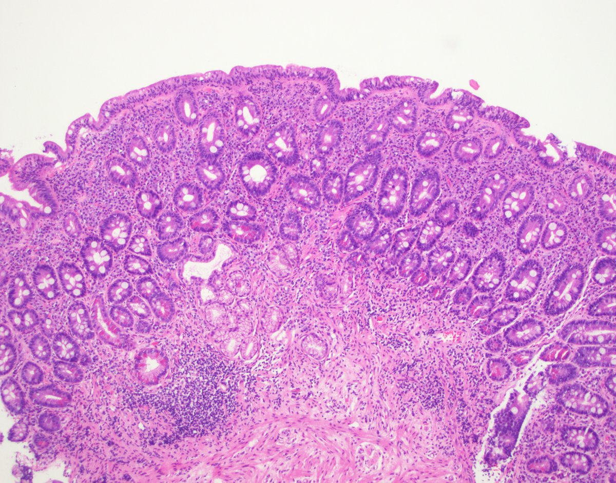 stephen_lagana's tweet photo. Can celiac disease be patchy? Check this case. Fragment on right totally normal. Frag on left evolving collagenous sprue! Good thing for generous sampling. #pathology  #celiac #GIpath  @BenjaminLebwohl https://t.co/IlzqPSPJKb