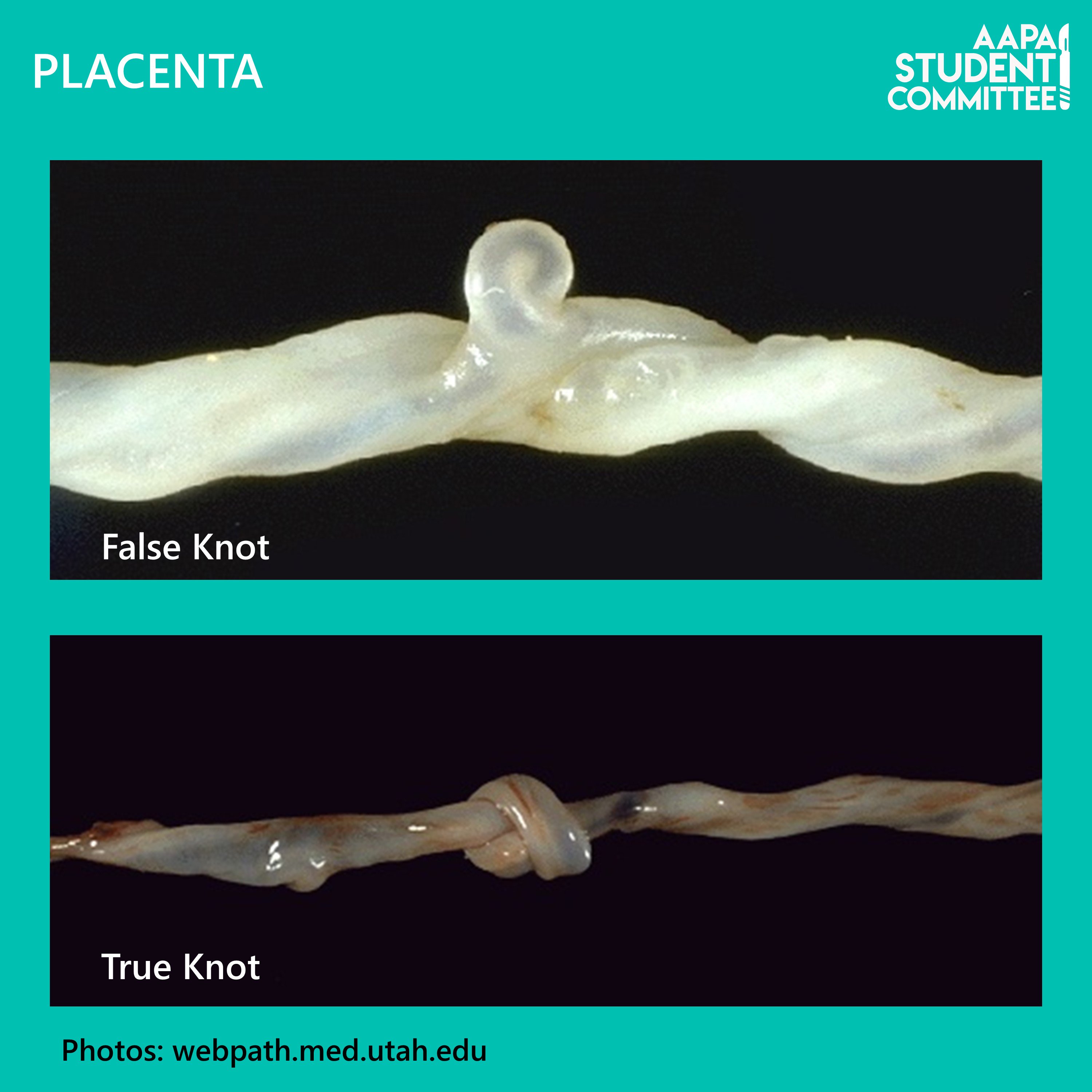 false-knot-umbilical-cord