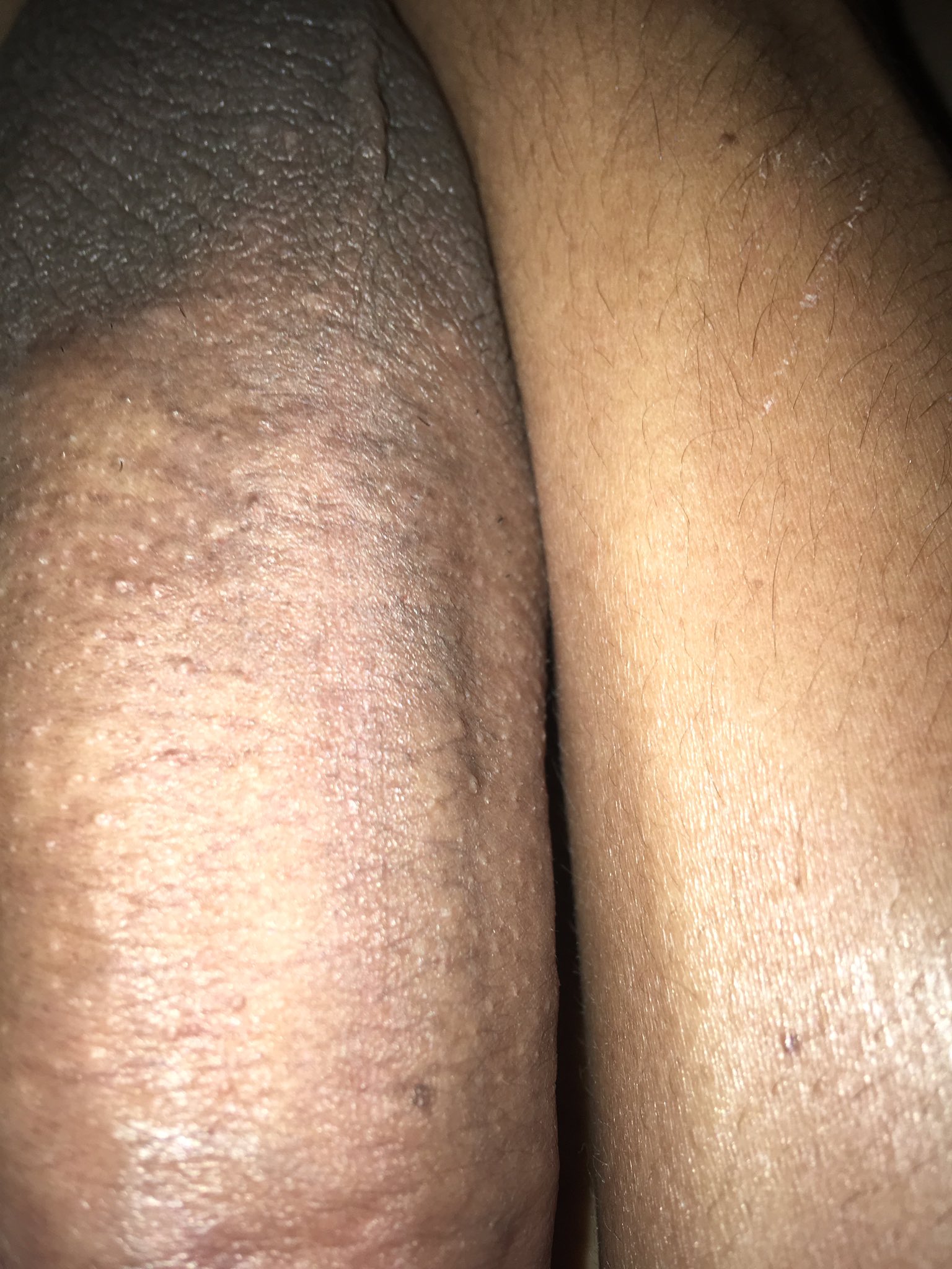 Tengo un problema de tonalidad de piel en mis brazos 🙃 https://t.co/HH8fRNjcRM