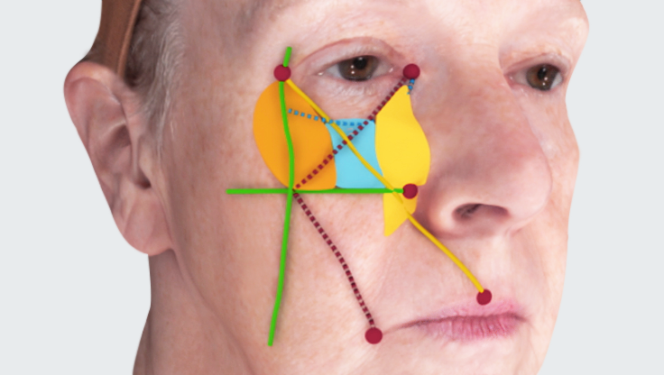 sciencestanding's tweet image. #3DFacialProceduresApp 3D pre-operative analysis provides an advanced view of safety harbors and adverse event zones of the midface, as well as the location and movement of the facial fat pads. Get the app: bit.ly/2FxcpHg

#plasticsurgery #dermatology #ophthalmology