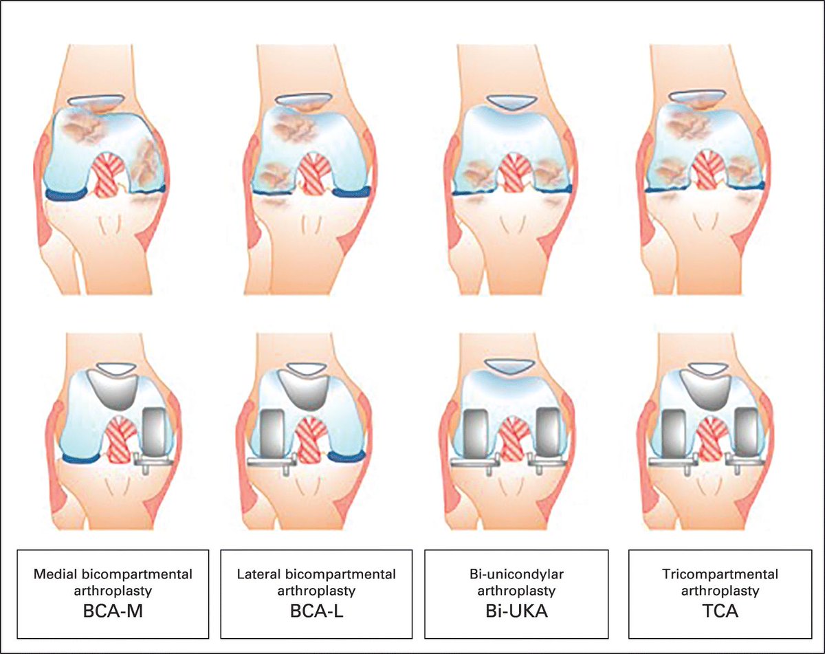 ImperialBiomechanics (@icbiomechanics) on Twitter photo Amy's new paper in <a href="/BoneJointJ/">The Bone & Joint Journal</a> classifies combined partial knee arthroplasty procedures. An important step to enable joint registry audit and meet modern patient safety standards. Great work Amy! doi.org/10.1302/0301-6… Amy's new paper in <a href="/BoneJointJ/">The Bone & Joint Journal</a> classifies combined partial knee arthroplasty procedures. An important step to enable joint registry audit and meet modern patient safety standards. Great work Amy! doi.org/10.1302/0301-6…