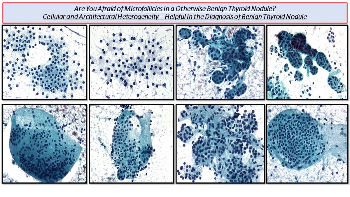 Zubair Baloch (@aakasharmand) on Twitter photo Basic Concepts in Thyroid FNA Cytology <a href="/EMadrigalDO/">Emilio Madrigal, DO</a> <a href="/marcoslepe/">Marcos Lepe</a> <a href="/edusqo/">Eduardo Alcaraz, MD PhD</a> <a href="/sam_albadri/">Sam Albadri, M.D., M.Sc.</a> <a href="/Sara_Jiang/">Xiaoyin "Sara" Jiang, MD (She/Her)</a> <a href="/DiagnosticCyto/">Diagnostic Cytopath</a> <a href="/SaudiCytopathol/">Hatim_Almaghraby_CytoPathologist_Saudi</a> <a href="/ekhanafshar/">Elham Khanafshar, MD, MS</a> <a href="/SteveLongMD/">Steven Long, MD</a> <a href="/pembeoltulu/">Pembe Oltulu, MD</a> <a href="/kriyer68/">Kalyani Bambal</a> @doc_kartik <a href="/mtsiddi/">Momin Siddiqui</a> @DrFNA <a href="/PennPathLabMed/">Penn Path & Lab Medicine</a> <a href="/IACytology/">International Academy Cytology</a> <a href="/tlabiano/">Tania Labiano</a> Basic Concepts in Thyroid FNA Cytology <a href="/EMadrigalDO/">Emilio Madrigal, DO</a> <a href="/marcoslepe/">Marcos Lepe</a> <a href="/edusqo/">Eduardo Alcaraz, MD PhD</a> <a href="/sam_albadri/">Sam Albadri, M.D., M.Sc.</a> <a href="/Sara_Jiang/">Xiaoyin "Sara" Jiang, MD (She/Her)</a> <a href="/DiagnosticCyto/">Diagnostic Cytopath</a> <a href="/SaudiCytopathol/">Hatim_Almaghraby_CytoPathologist_Saudi</a> <a href="/ekhanafshar/">Elham Khanafshar, MD, MS</a> <a href="/SteveLongMD/">Steven Long, MD</a> <a href="/pembeoltulu/">Pembe Oltulu, MD</a> <a href="/kriyer68/">Kalyani Bambal</a> @doc_kartik <a href="/mtsiddi/">Momin Siddiqui</a> @DrFNA <a href="/PennPathLabMed/">Penn Path & Lab Medicine</a> <a href="/IACytology/">International Academy Cytology</a> <a href="/tlabiano/">Tania Labiano</a>