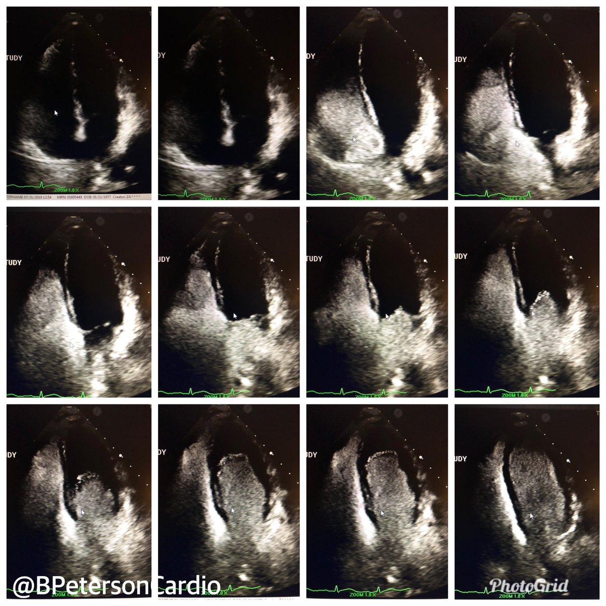 Collage of echo bubble study images in young patient admitted with acute hemiparesis (see thread for the video)
<a href="/ASE360/">American Society of Echocardiography</a> #echofirst #cardiotwitter #CardioEd
