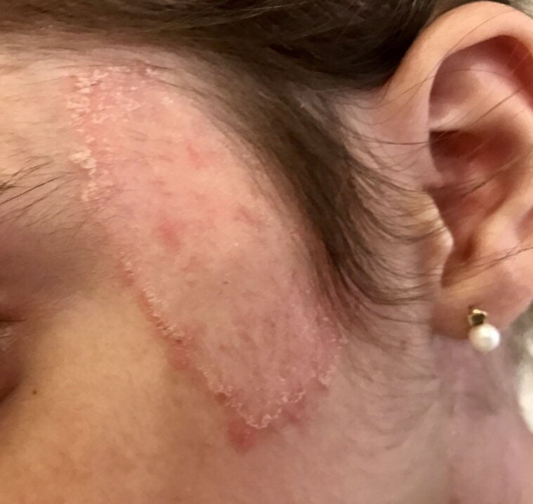 “‘Me han regalado un gatito”. Y desde entonces tengo esto en la cara que me crece. Diagnóstico: tinea faciei. Infección por hongos dermatofitos. #dermatologia
