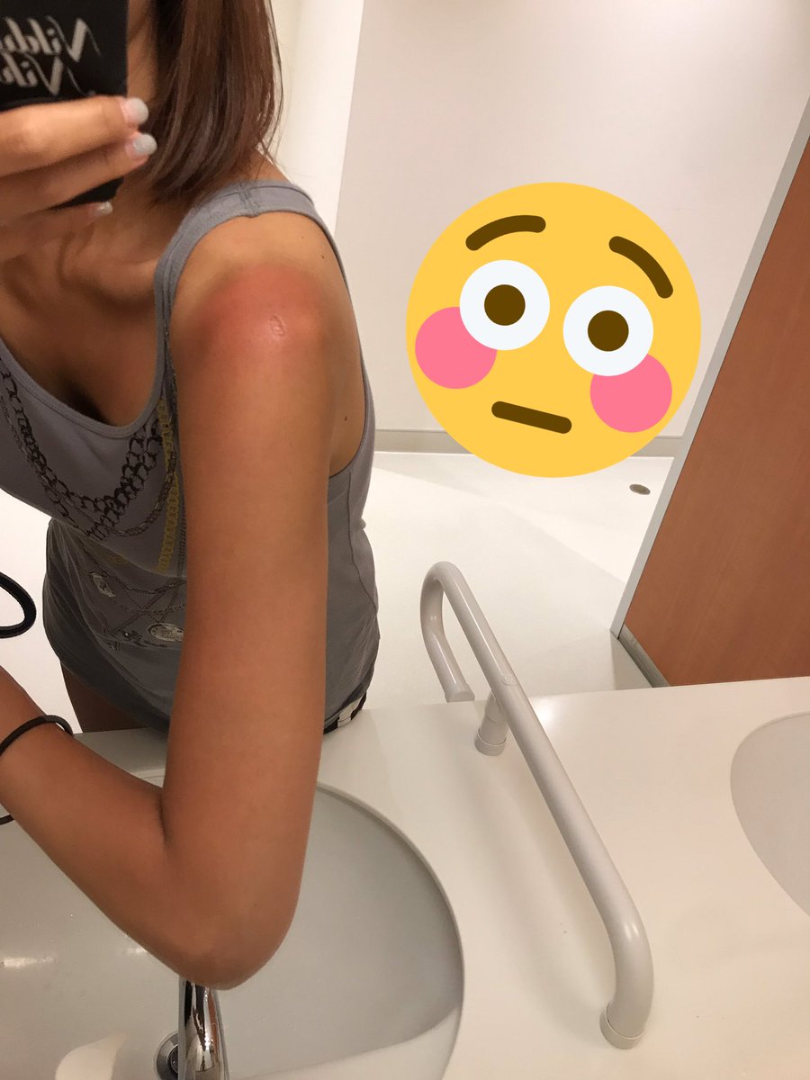 すのこ V Twitter 日焼けの跡落ち着いてきたとは言え何故だろう 黒じゃなくて赤い そして肩ぶつけた拍子に皮むけた