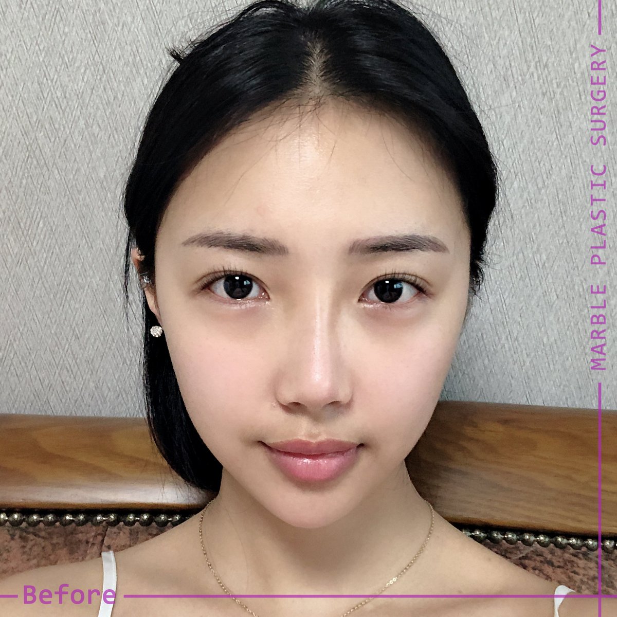 マーブル美容整形外科 A Twitter これ以上失敗したくない 鼻筋から鼻先まで結果が証明するマーブル鼻再手術 手術内容 鼻再手術 担当医 ソ イルボム代表院長 お問い合わせはこちら T Co Xepvu6jzhe 韓国美容 韓国整形 美容整形 鼻形成 鼻 マーブル美容整形外科 A Twitter これ以上失敗したくない 鼻筋から鼻先まで結果が証明するマーブル鼻再手術 手術内容 鼻再手術 担当医 ソ イルボム代表院長 お問い合わせはこちら T Co Xepvu6jzhe 韓国美容 韓国整形 美容整形 鼻形成 鼻