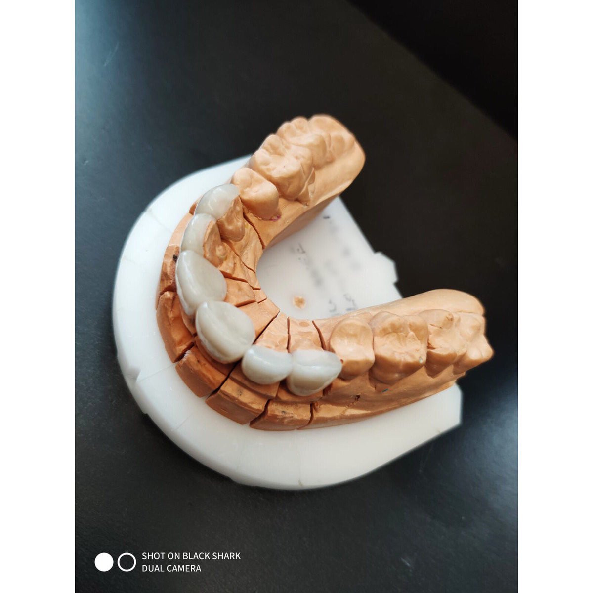 optimum_dental's tweet photo. These #emax #emaxveneers look so #natural the #staining is #onpoint 💪🏽🙌🏽😍👏🏽 #outthere #smileagain #smile #smiles #dental #dentist #dentistry #compositebonding #emaxpress #emaxdesign #toothbrush #oralhealth #cosmeticdental https://t.co/7SwPLTqgcF