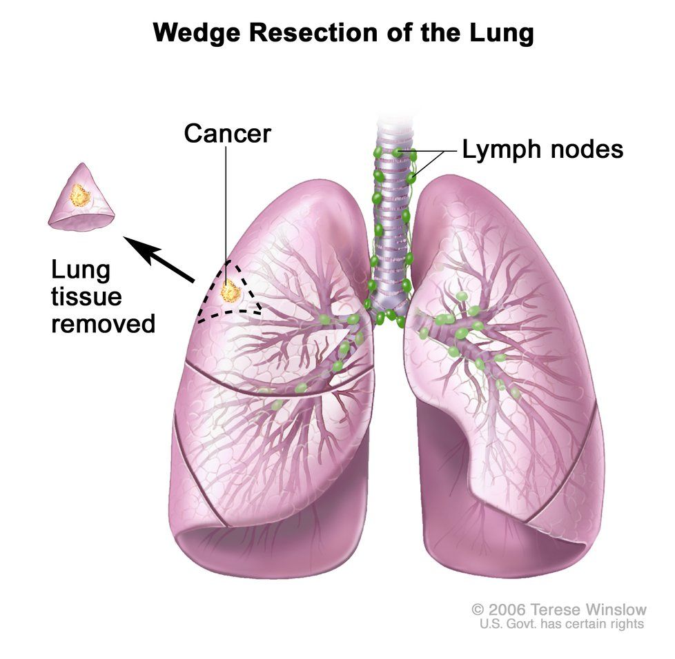 theNCI's tweet image. What's the latest in lung cancer research? Here are some recent advances: cancer.gov/types/lung/res… #worldlungcancerday #lungcancer #lcsm