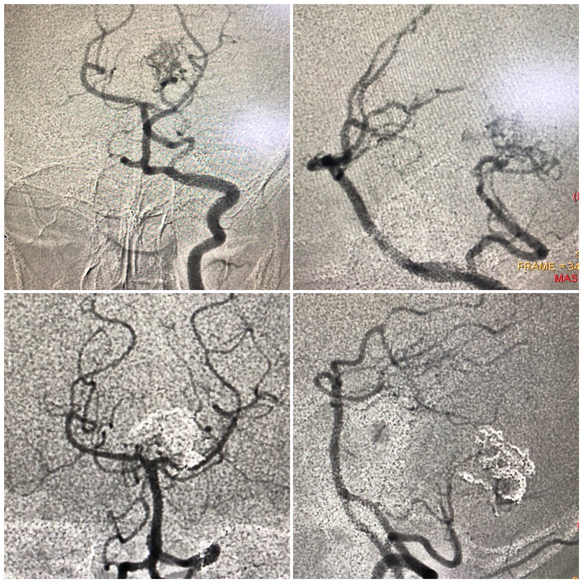 drmostafafarid's tweet photo. Yesterday’s case #AVM #embolization #emergency #endovascular #InterventionalRadiology #InterventionalSpecialists #IRad #JNIS #Neuro #neurosurgery #SNIS2019 #SpectrumStrokeStrong #StrikeOutStroke #Stroke #SVIN #strokedocs #vascularmalformations https://t.co/5qbotcO6pl