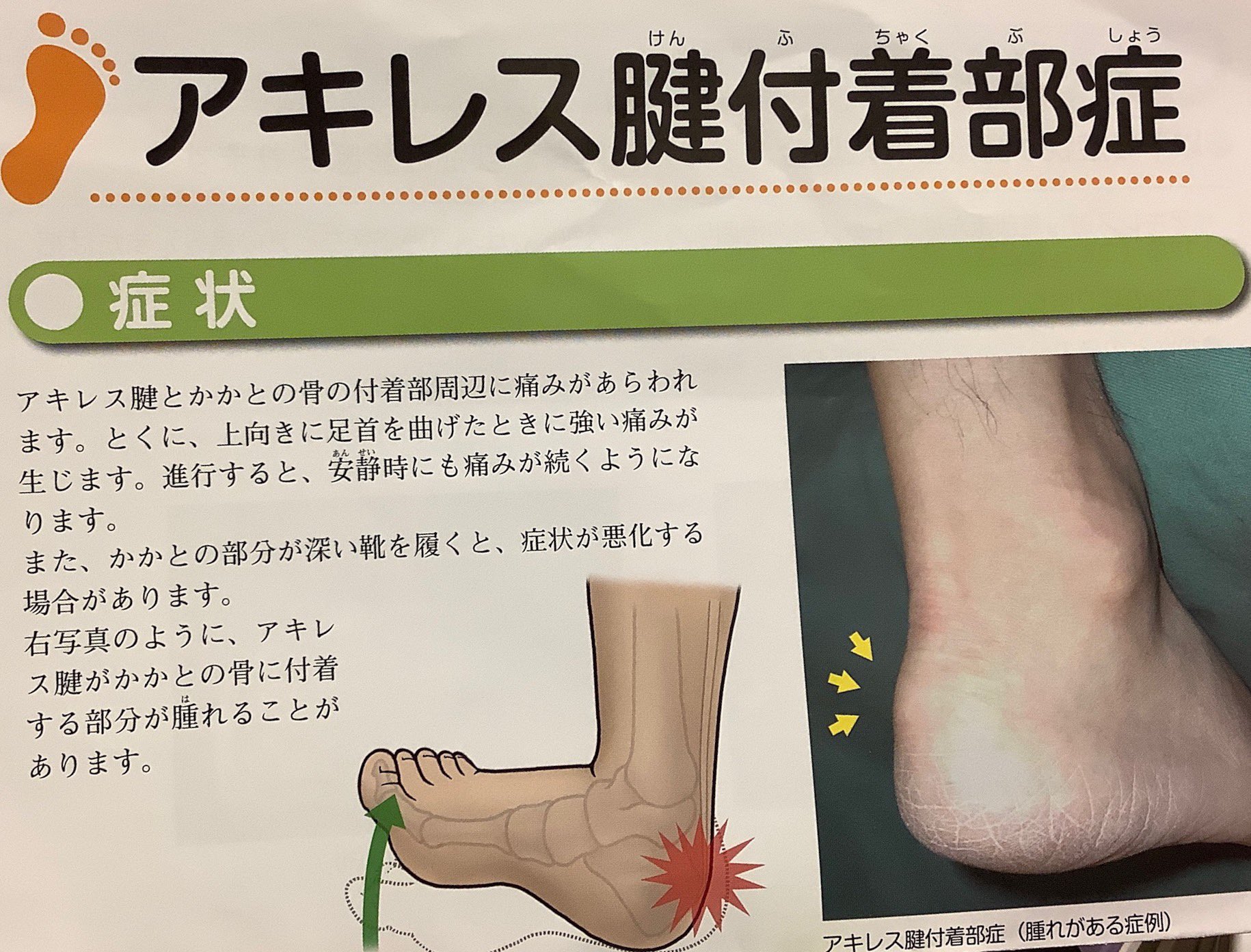 やぶ Twitterissa ここ数日 歩くと踵に痛みを覚え整形外科を受診した アキレス腱付着部症 との診断だった 踵の骨のトゲが原因らしい 多くの場合痛みを感じないらしいが何かの拍子で痛み出したらしい 特に太り気味の人に症状が現れやすいとのこと 鎮痛薬と貼り