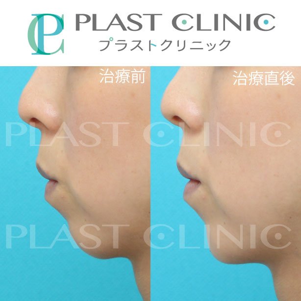 ほう れい 線 ヒアルロン 酸 プラスト くり に っ く