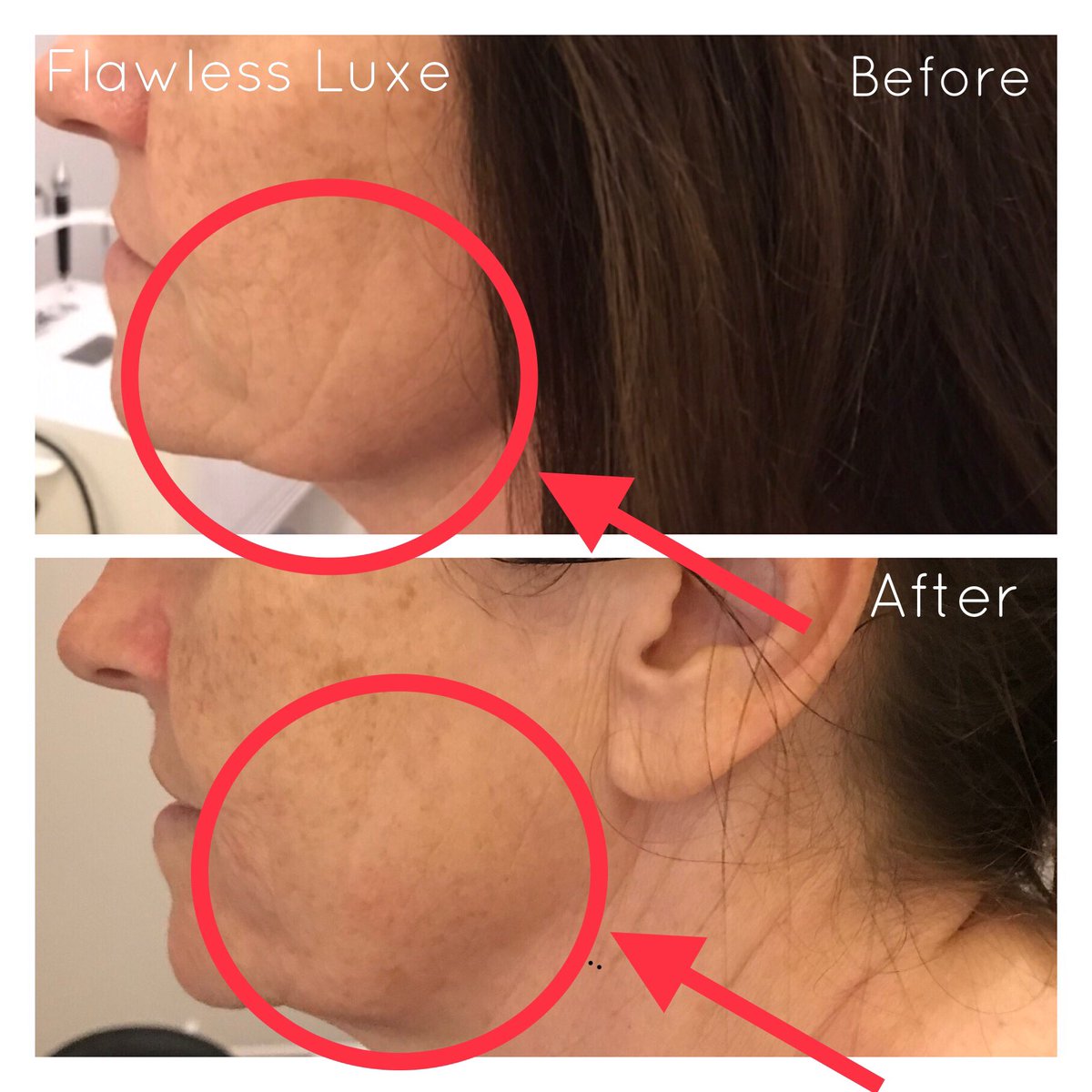 FlawlessLuxe's tweet photo. Before and after here @flawlessluxe 🙌🙌 fantastic results using our non-surgical face lifting treatment 😍call 02476712192 to book your FREE consultation today #nonsurgical #facelift #beforeandafter #linereduction #antiageing #facial #microcurrentfacial #7in1 #system https://t.co/Kr7NUgldOx
