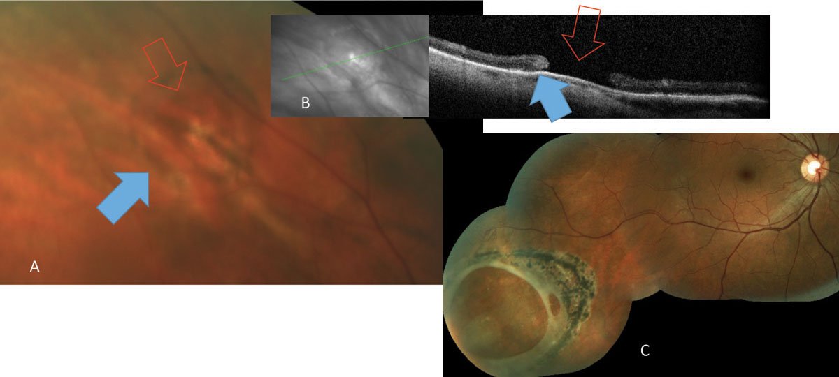 revoptom's tweet photo. Retinal holes and tears are commonly encountered during dilated fundus examination of symptomatic and asymptomatic patients. Retinal defects come in different shapes and sizes and partial or full thicknesses. Their causes are equally varied.

Read more:
https://t.co/0klvJVhxu9 https://t.co/gWMqLlsN9i