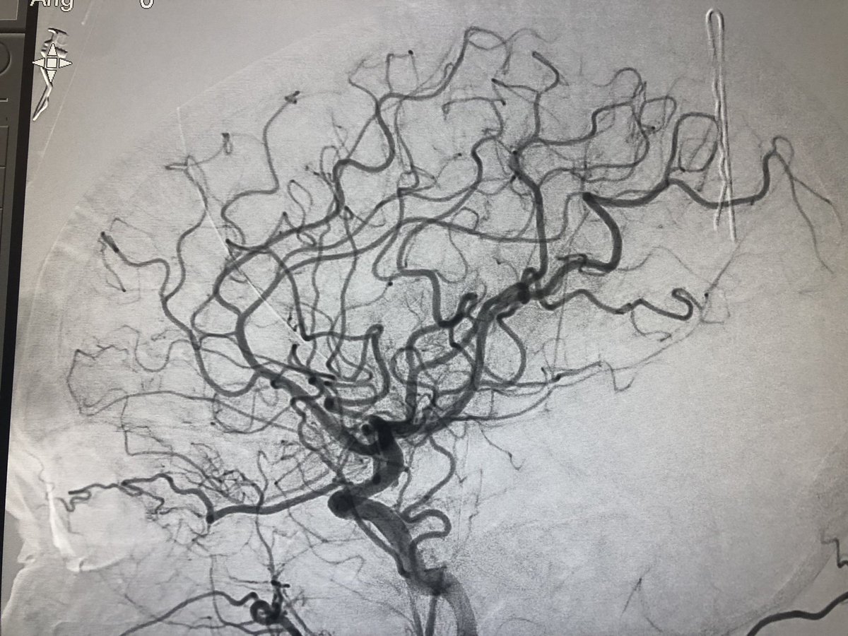 Barts Health Interventional Neuroradiology tweet media