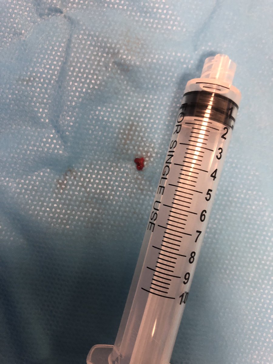 M2 and A3 occlusions. #MIVI Q3 for M2. #BALT catch mini for A3 to #GTFVO TICI 3. Patient improved on table. #leavenoELVObehind