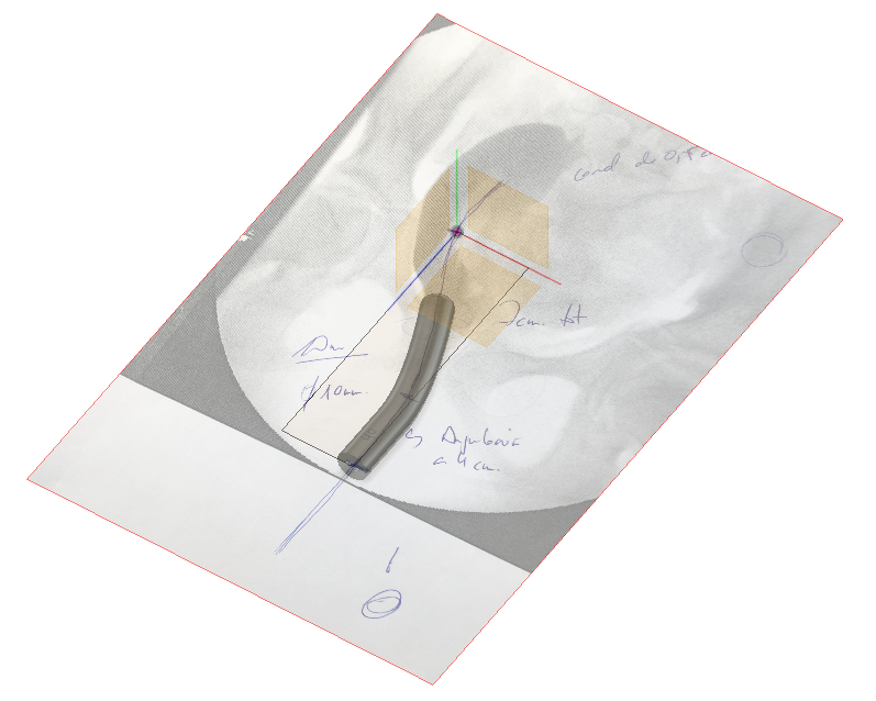 3d_maranon's tweet photo. Dilators for use in patients that have undergone a vaginal reconstruction. Custom designed for each case in Fusion 360 according to the surgeon indications and patient measurements.

Work by the Marañón FabLab Team @rupermac @calvoharo_ja @diegotrap @kn_ord @AbyAmselem https://t.co/KK5pDSOTY7