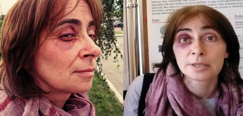 miptstream's tweet image. На фото Виктория Скобеева – кандидат биологических наук, научный сотрудник МГУ и лектор по общей биологии на Физтехе. Она пострадала на несогласованном митинге 27 июля. Двух ее коллег задержали, сама женщина получила дубинкой по лицу.

miptstream.ru/2019/08/02/sko…