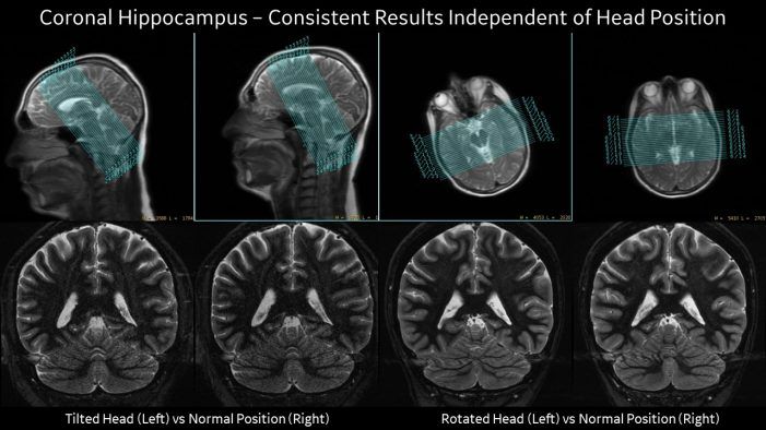 GEHealthCare's tweet image. No matter how you slice it, this #AI tech is changing #MRI neuro imaging invent.ge/2unXdX8