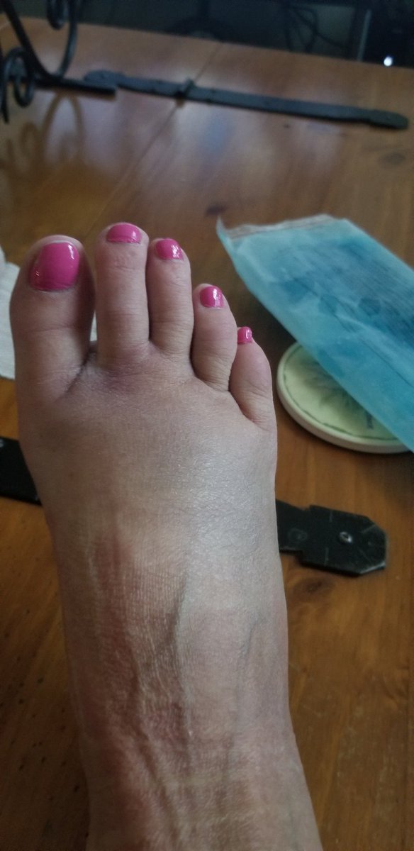 chloesmom28's tweet photo. Never jump in the shallow end of a pool!
#brokenheel
#brokenankle 
#OUCH😫
#hardcastcoming
#anothersurgery 

#totallysober
#dumbblond 
#Stupidhumantricks 😅 https://t.co/NQhcVDKXbd
