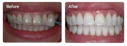 Would you like to enjoy a brighter smile for summer? Get in touch to find out more about Enlighten Whitening teeth.clinic/whitened3
#WhiteTeeth #TeethWhitening