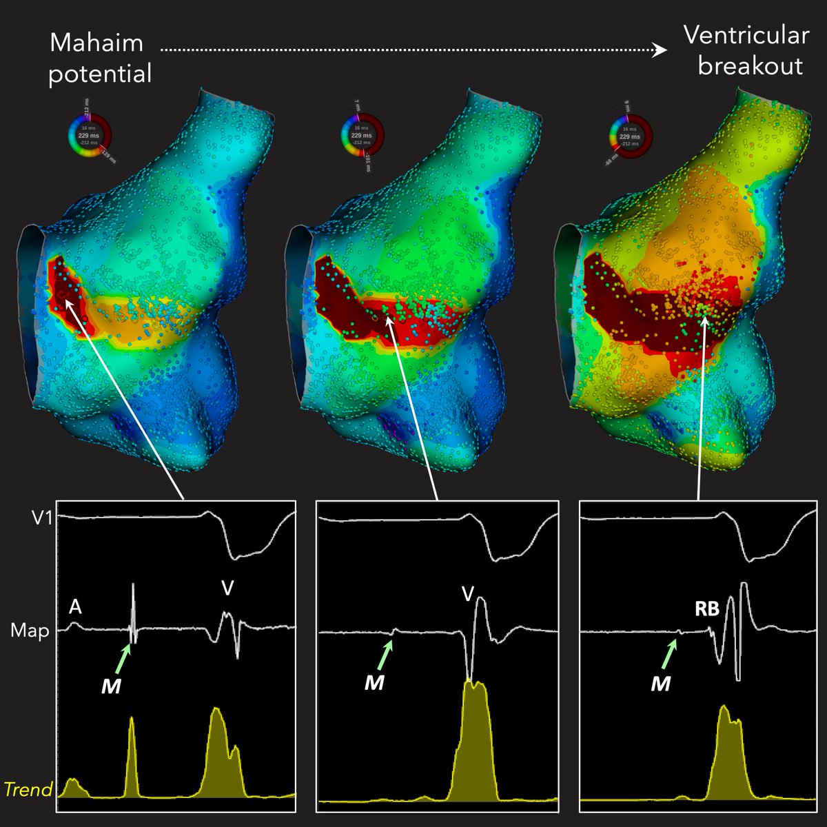 Roderick Tung (@drrodericktung) on Twitter photo <a href="/ZJameria/">Zenith Jameria</a> AP potential was largest at annulus but targeting anywhere along the tract would likely eliminate atriofascicular connection. Trend tool with Rhythmia very nice way to show a population of these potentials. <a href="/ZJameria/">Zenith Jameria</a> AP potential was largest at annulus but targeting anywhere along the tract would likely eliminate atriofascicular connection. Trend tool with Rhythmia very nice way to show a population of these potentials.