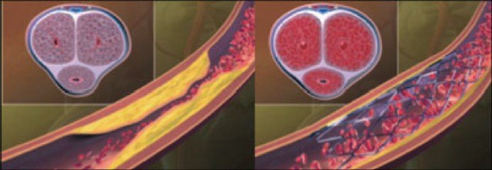 AndrologyGyn's tweet photo. Shock Wave Therapy inVasculogenic Erectile Dysfunction: Objective: The aim of this study is to evaluate the response to shock wave therapy in a group of patients with vasculogenic erectile dysfunction after underwent deep dorsal vein embolization...https://t.co/Vc5Pn2o4cD https://t.co/MGO5hDYIPi