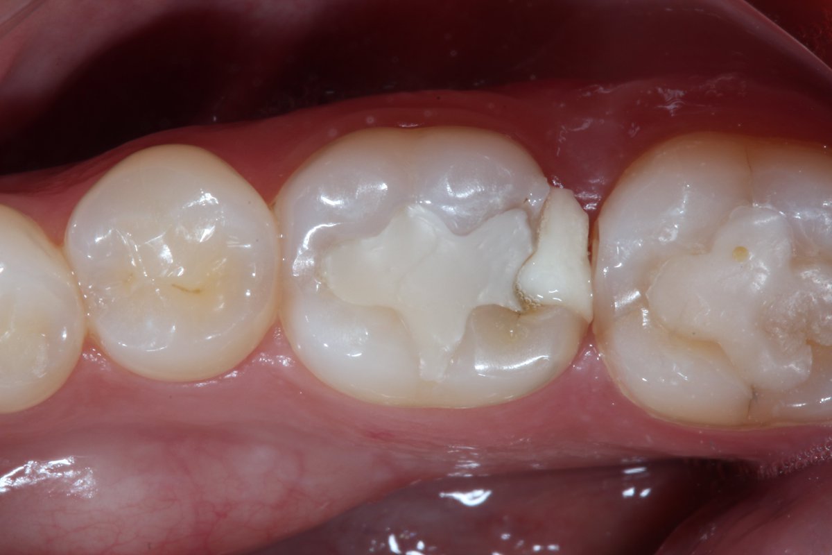 psdivya1267's tweet photo. A #dental restoration or dental filling is a #treatment to restore the function, integrity, &amp; morphology of missing #tooth structure resulted from #caries or external trauma. #Restorations can be of direct or indirect.
Submit your abstracts on the same @ https://t.co/ryOS2ONvdT https://t.co/Nk32rItcRr