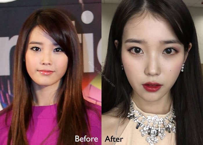 Why do we have a problem with HER having plastic surgery when other idols a...