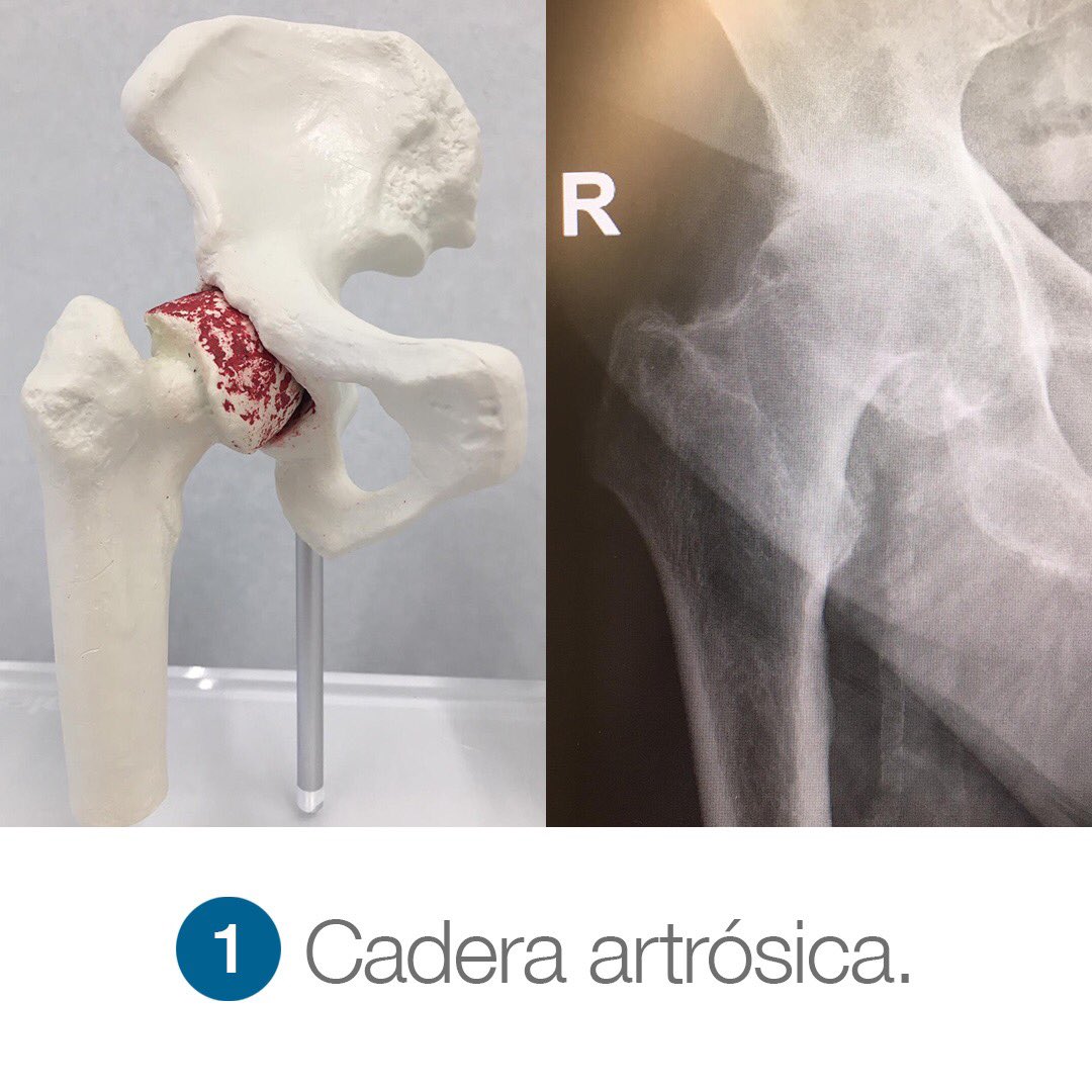 DrJuanPrieto's tweet photo. Al igual que otras articulaciones, la cadera puede presentar degeneración por procesos mecánicos, traumáticos, inflamatorios y otros. Esto provoca en la mayoría de los casos dolor inguinal irradiado hacia el muslo.
#artrosiscadera #miniinvasiva #doloringuinal #cun #drprieto https://t.co/qKArzSxkVO