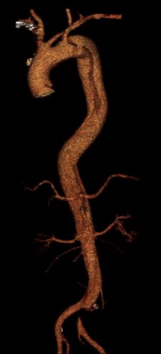 BruceTjadenMD's tweet photo. Second #Acute #TypeB #AorticDissection I've treated recently for left leg #Malperfusion. Great result after stentgrafting of thoracic aorta with improved true lumen filling through left common iliac artery. Also, illustrates the accuracy of a good CT scan / TeraRecon. https://t.co/HOsNN0bd6x
