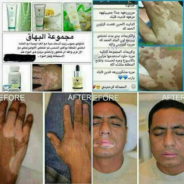 sigofcdivos's tweet photo. مجموعة الاكزيما:- هذه المنتجات من فوريفر أثبتت فاعليتها في المساعدة على الشفاء من مرض الاكزيما، يتم تنظيف الجلد بالصابون السائل الغني بمادة الصبار الطبيعية، ثم يتم خلط كمية بسيطة ومتساوية من كل من كريم الألوفيرا جيلي وكريم البروبولس مع قطرات من ألو أكتفيتور

#صابرين_بورشيد https://t.co/2xS5TlL7zh