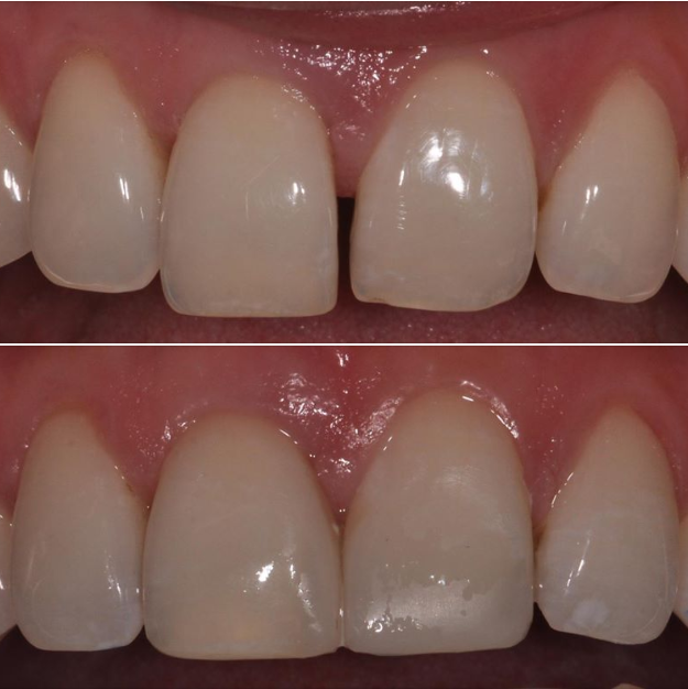 The difference some composite bonding can make!
north.clinic/dental1
#DentistTime #DentistVisit