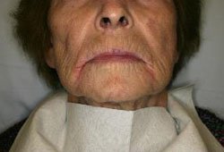 BMJBestPractice's tweet photo. Do you know how you would #investigate and #treat this patient with #angular #cheilitis? See BMJ Best Practice for suggested investigations and #management options. https://t.co/XaE5voI6ym https://t.co/dZ6Tpdr59T