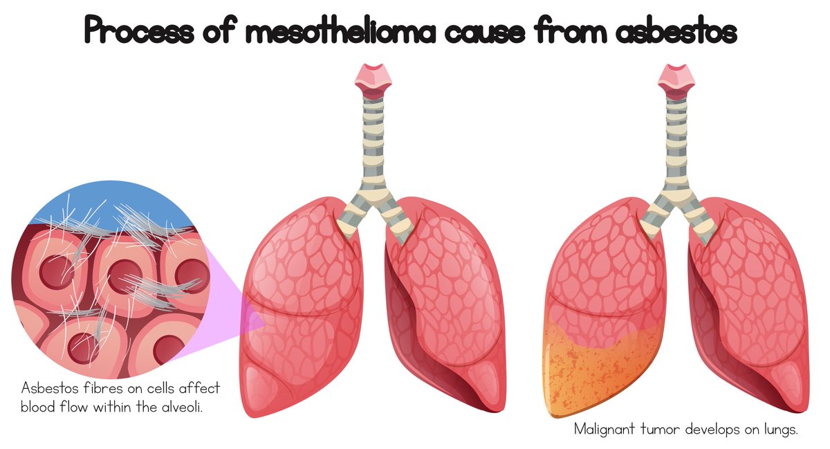 mesothelioma epidemiology