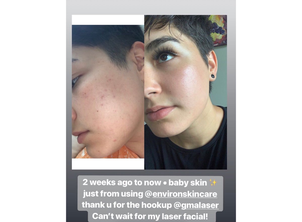 GenMedAesthetic's tweet photo. We love when our clients see results🙌🏻 #gmalaser #aesthetics #environskincare https://t.co/bSdnGcVSAB