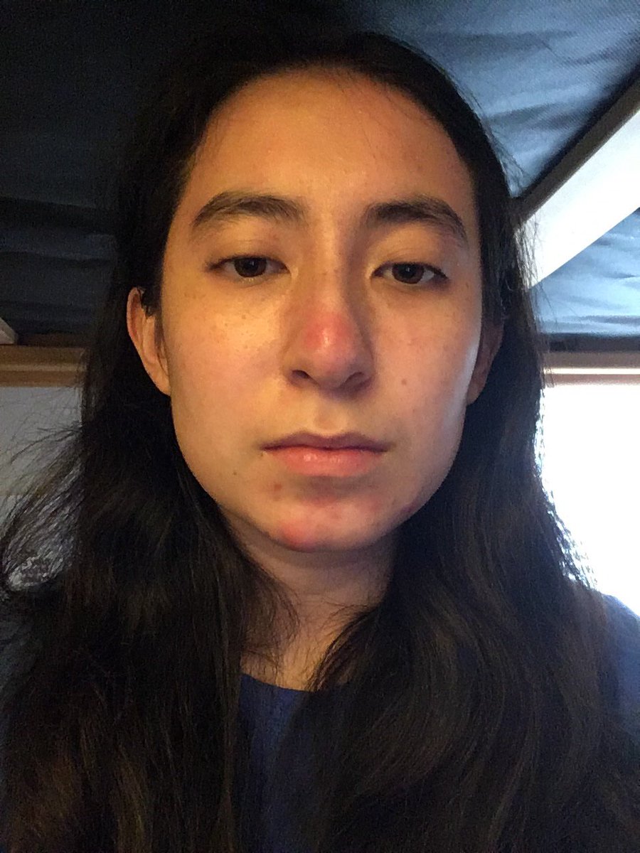 ejohnson314's tweet image. Rudolph the red nosed Emily #pimpleproblems