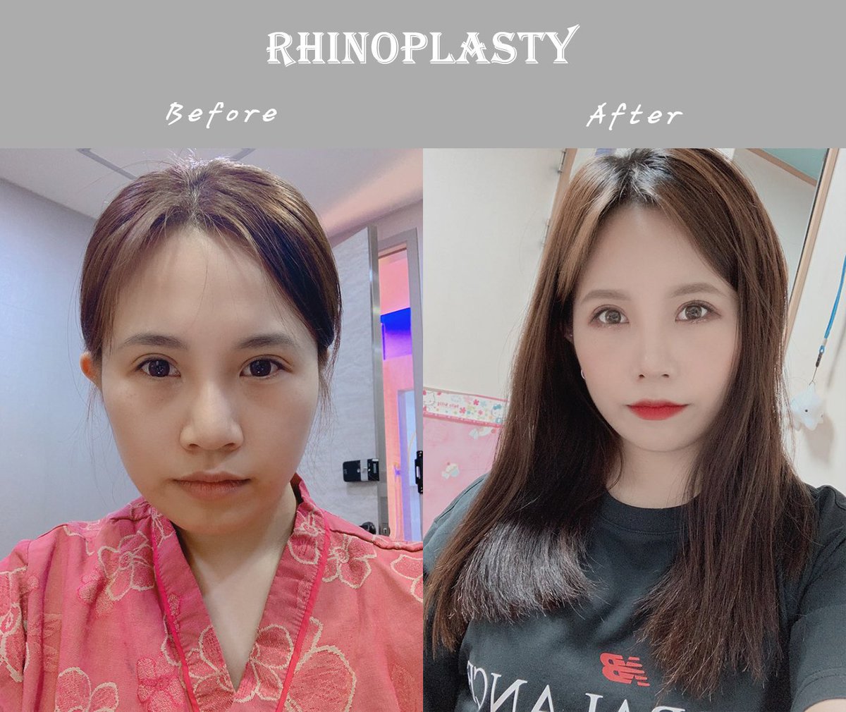 PsSeoul's tweet photo. Before and after pictures of full rhiniplasty procedure.
#plasticsurgery #rhinoplasty #doctors #beforeandafter #nosejob #SouthKorean #seoulqueenplasticsurgery https://t.co/zmtzFd8cPF