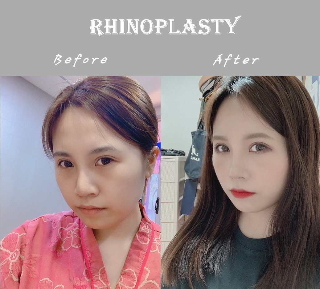 PsSeoul's tweet photo. Before and after pictures of full rhiniplasty procedure.
#plasticsurgery #rhinoplasty #doctors #beforeandafter #nosejob #SouthKorean #seoulqueenplasticsurgery https://t.co/zmtzFd8cPF