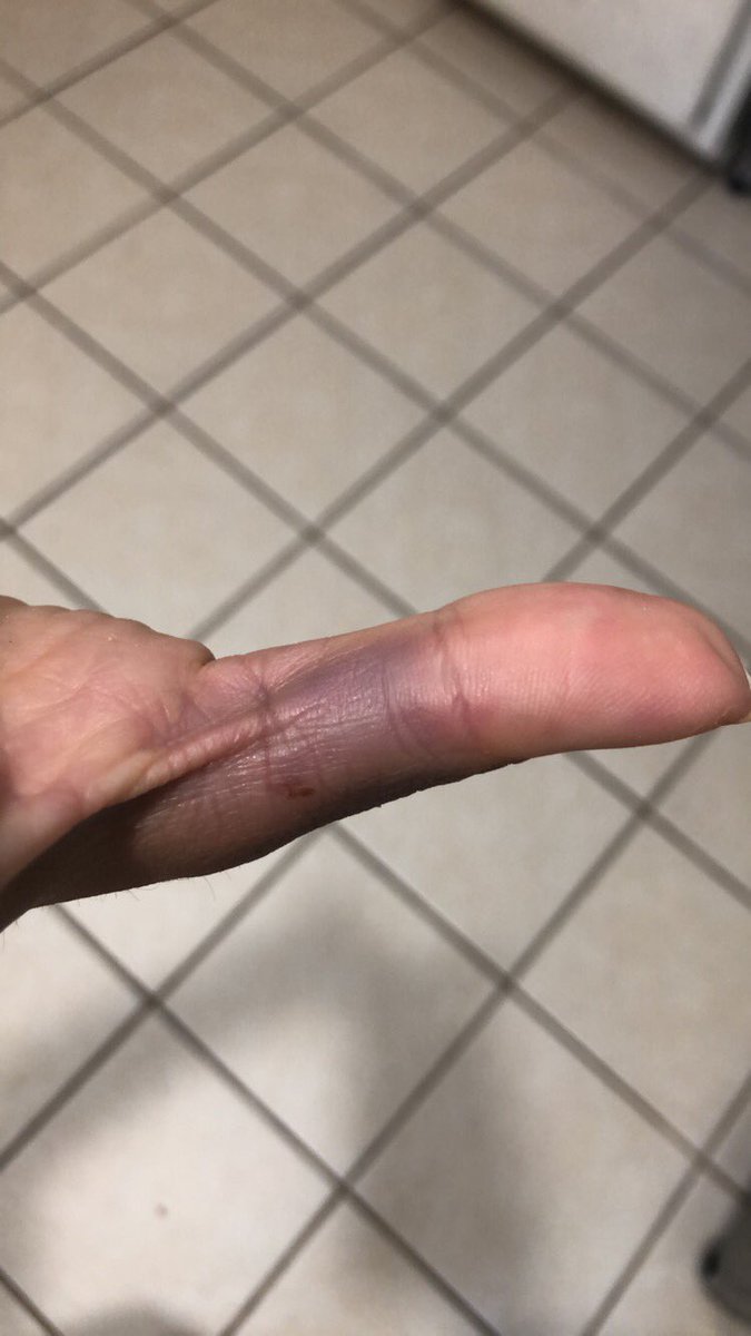 Smashing your finger between the bar and the plates. Leaves a good mark #liftingproblems #gymaccidents