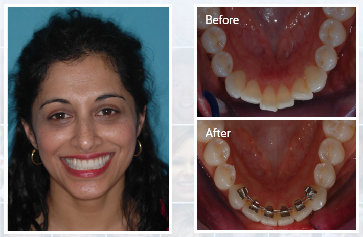 This patient wanted a discreet solution to align her crowded lower teeth. They were aligned using social 6 lingual braces.
great.social/stb6
#StraightTeeth #Pinner