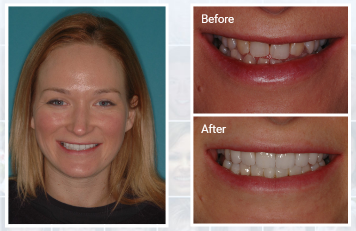 Porcelain veneers were used to align these rotated teeth. A more developed "smile curvature" was created to complete this smile makeover.
visit.dental/veneer5
#WhiteTeeth #Veneers