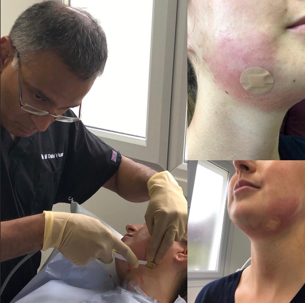 InmodeUK's tweet image. Plastic Surgeon, Dr Dalvi Humzah performs an AccuTite &amp;amp; Morpheus8 procedure on a female patient who travelled all the way from Amsterdam! It was a 45 minute treatment to contour &amp;amp; define her jawline
.
A walk-in-walk-out procedure with minimal downtime and no scarring @pdsurgery