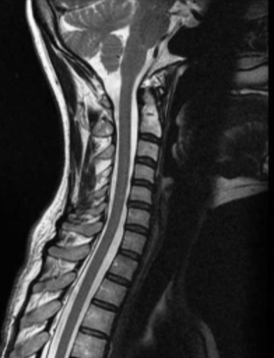drcorenman's tweet image. #Kyphosis is a #spinaldisorder in which an excessive outward curve of the #spine results in an abnormal rounding of the upper back. Condition is known as &quot;roundback&quot; or—in the case of a severe curve—as &quot;hunchback.&quot; Kyphosis can occur at any age, but...medilink.us/wgvs