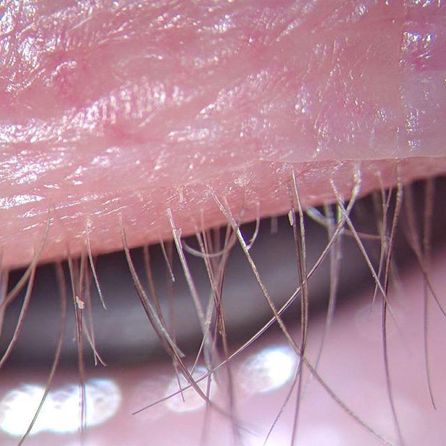 Zocular's tweet image. No one wants these little “friends” around.  Mites, mites and more mites.  Eyelid / lash hygiene is so very important for this reason. .
.
.
.
.
#zocular #vision #2020 #lash #blepharitis #eyehealth #eyecare #eyedoctor #eyesonyou #beauty #dryeye #eyelashe… ift.tt/30SuJ68