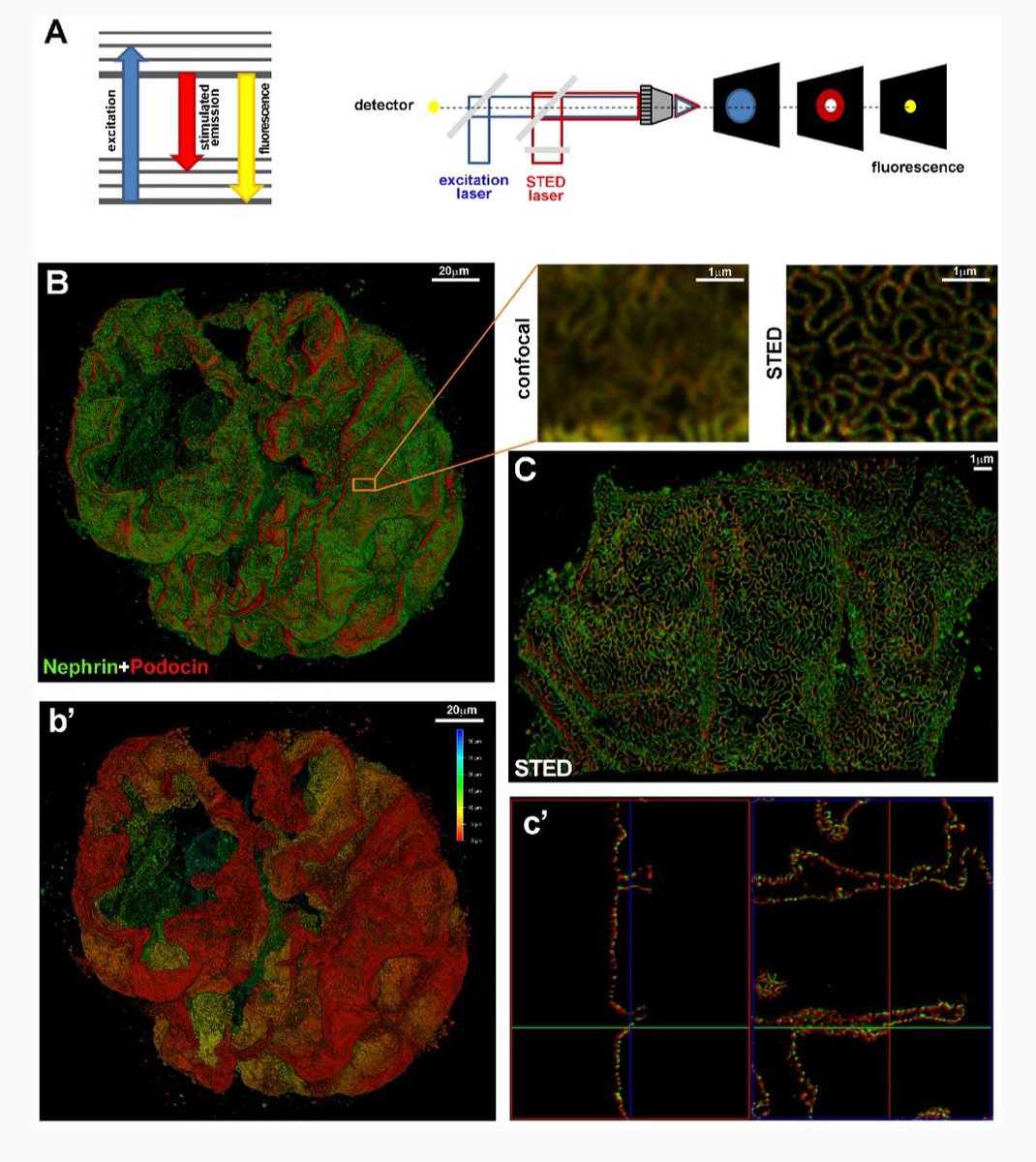 Carolina Conte (@carolinaconte5) on Twitter photo Imaging the kidney: from light to super-resolution microscopy academic.oup.com/ndt/advance-ar… <a href="/NDTsocial/">NDT</a> <a href="/LeicaMicro/">Leica Microsystems</a> <a href="/SRMicro_papers/">Super Res Microscopy</a> <a href="/womeninnephro/">Women In Nephrology</a> <a href="/embl/">EMBL</a>
#kidney #microscopy #sted #imaging #superresolution Imaging the kidney: from light to super-resolution microscopy academic.oup.com/ndt/advance-ar… <a href="/NDTsocial/">NDT</a> <a href="/LeicaMicro/">Leica Microsystems</a> <a href="/SRMicro_papers/">Super Res Microscopy</a> <a href="/womeninnephro/">Women In Nephrology</a> <a href="/embl/">EMBL</a>
#kidney #microscopy #sted #imaging #superresolution
