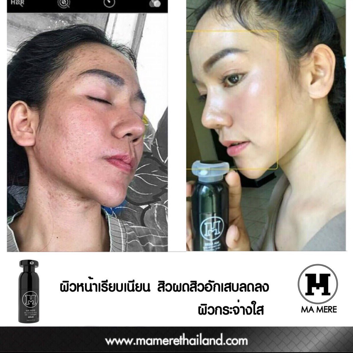 KYBeauty08's tweet photo. เรื่องรอย เรื่องผิว ชิวได้เพราะ #MamereSerum✨ยิ่งทายิ่งใส ยิ่งใช้ยิ่งตึง 👌🏻👌🏻 อายุเยอะอย่าให้ตึงแต่หูนะจ๊ะ ผิวเราก็ต��องตึง‼️

นึกถึงผิวใส นึกถึง #KYBeauty #เตาปูน #บางซื่อ #BTS #MRT
สั่งซื้อ | สอบถามปัญหาผิว 
➡️ https://t.co/FHXAjh1X7k https://t.co/RWDp6YMlJN
