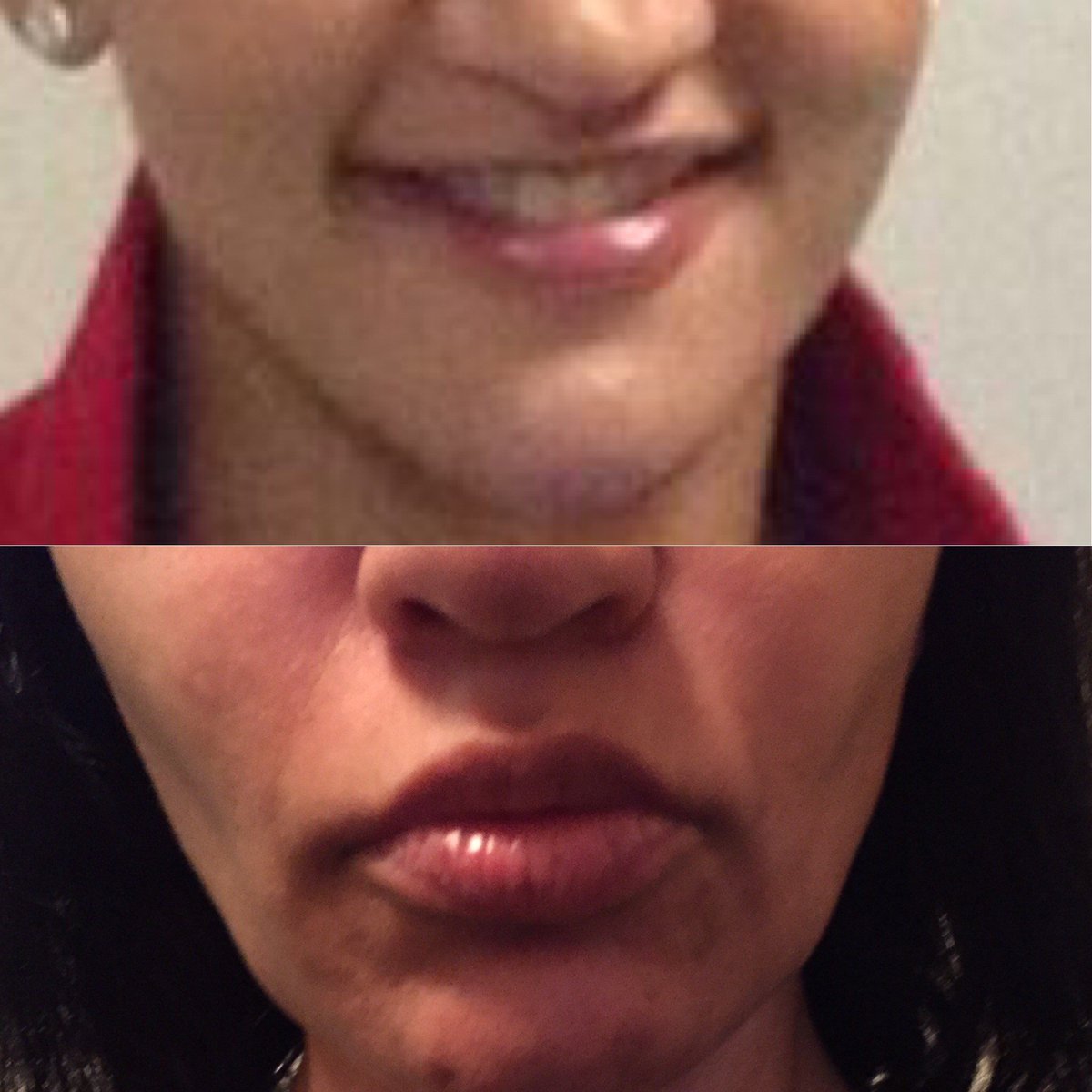 UltherapyDmg's tweet photo. Learn about Ultherapy damage before it's too late. Check out my review on https://t.co/nCPB4ztgGo and many others who had devastating results. #Ulthera
#Ultherapy #Merz #Realself #myultherapydamage #ultheranightmare #medwatch #ultherapynervedamage #ultherasideeffects #necklaxity https://t.co/ygANft74Sw